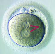 in vitro fertilization
