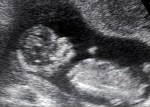Pippa 3 month fetus